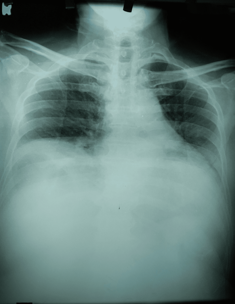 foto derrame pleural icono