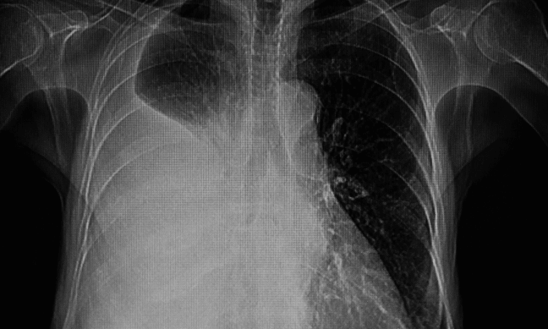 foto derrame pleural portada