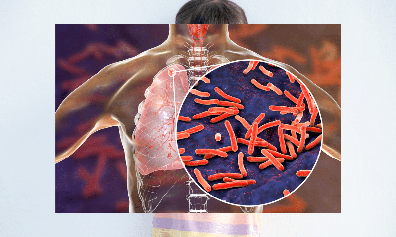 tuberculosis pagina inicio